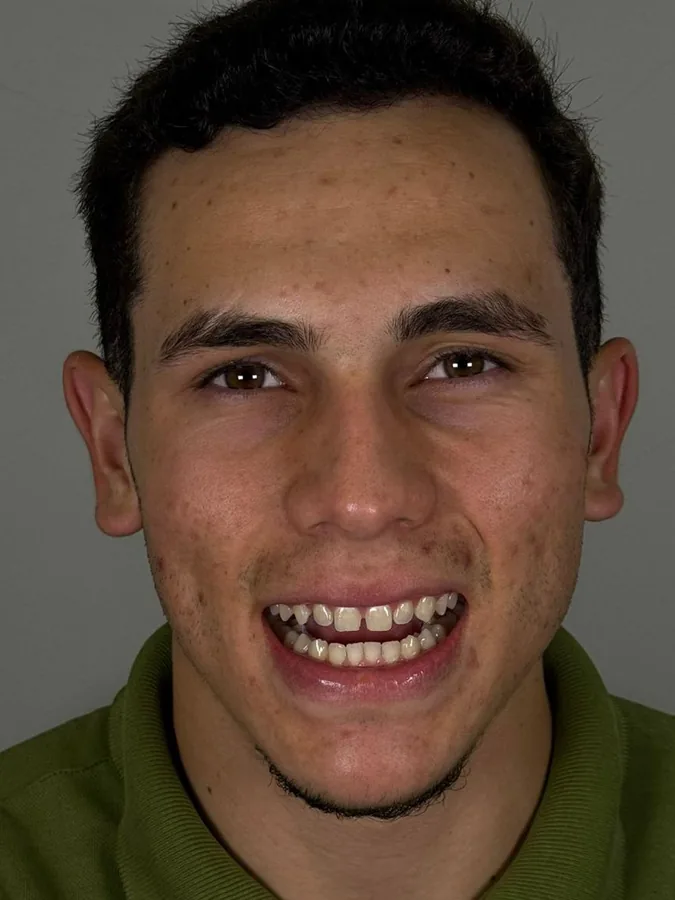 Paciente antes do tratamento com facetas na DentoEssence Santos